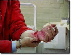 First Aid